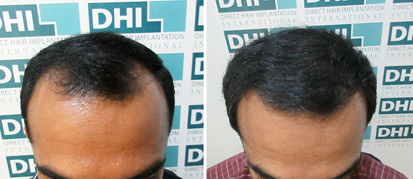 DHI before & after hair transplant results